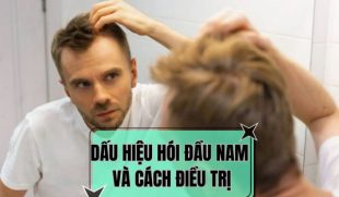 Dấu hiệu hói đầu ở nam và cách điều trị hiệu quả
