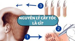 Nguyên lý cấy tóc là gì? Giải thích đơn giản cho người mới