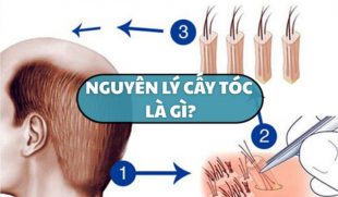 Nguyên lý cấy tóc là gì? Giải thích đơn giản cho người mới