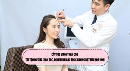 Cấy tóc vùng trán cao: Tái tạo đường chân tóc, định hình cấu trúc gương mặt hài hòa hơn