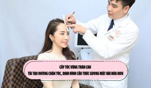Cấy tóc vùng trán cao: Tái tạo đường chân tóc, định hình cấu trúc gương mặt hài hòa hơn