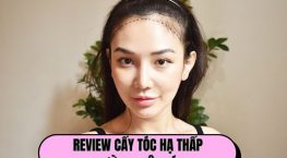 Review cấy tóc hạ thấp đường chân tóc từ khách hàng thực tế