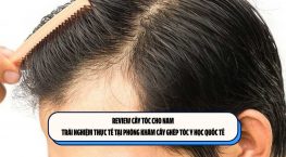 Review cấy tóc cho nam: Trải nghiệm thực tế tại Phòng khám Cấy ghép tóc Y học Quốc tế