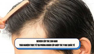 Review cấy tóc cho nam: Trải nghiệm thực tế tại Phòng khám Cấy ghép tóc Y học Quốc tế