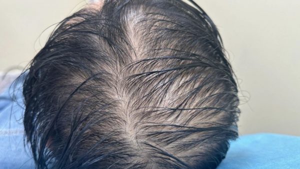 Rụng tóc do đội mũ bảo hiểm phải làm sao? Rụng tóc do đội mũ bảo hiểm phải làm sao?