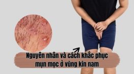 Giải mã hiện tượng mụn mọc ở vùng kín nam – Đừng chủ quan!