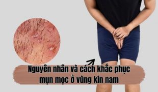 Giải mã hiện tượng mụn mọc ở vùng kín nam – Đừng chủ quan!