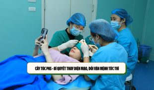 Cấy tóc PNS – Bí quyết thay diện mạo, đổi vận mệnh tức thì