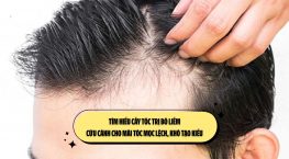 Tìm hiểu cấy tóc trị bò liếm: Cứu cánh cho mái tóc mọc lệch, khó tạo kiểu