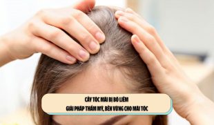 Cấy tóc mái bị bò liếm – Giải pháp thẩm mỹ, bền vững cho mái tóc