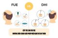 Cấy tóc DHI và FUE: Hướng dẫn chọn giải pháp hiệu quả và an toàn