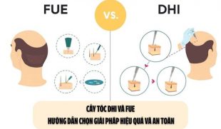 Cấy tóc DHI và FUE: Hướng dẫn chọn giải pháp hiệu quả và an toàn
