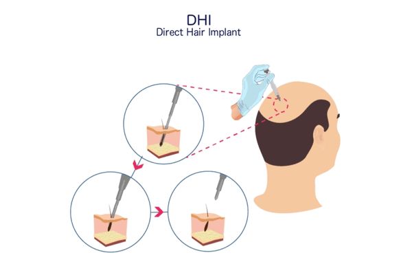 Cấy tóc DHI và FUE: Hướng dẫn chọn giải pháp hiệu quả và an toàn Cấy tóc DHI và FUE: Hướng dẫn chọn giải pháp hiệu quả và an toàn