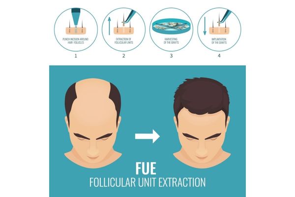 Cấy tóc DHI và FUE: Hướng dẫn chọn giải pháp hiệu quả và an toàn Cấy tóc DHI và FUE: Hướng dẫn chọn giải pháp hiệu quả và an toàn