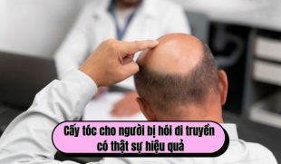 Cấy tóc cho người bị hói di truyền có thực sự hiệu quả?