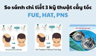 Chuyên gia chia sẻ về 3 công nghệ cấy tóc FUE, HAT, PNS
