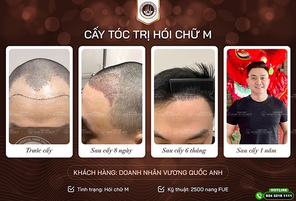 Cấy tóc cho đầu hói – Tất tần tật những điều bạn cần biết trước khi thực hiện