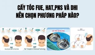 Cấy tóc FUE, HAT, PNS và DHI nên chọn phương pháp nào?