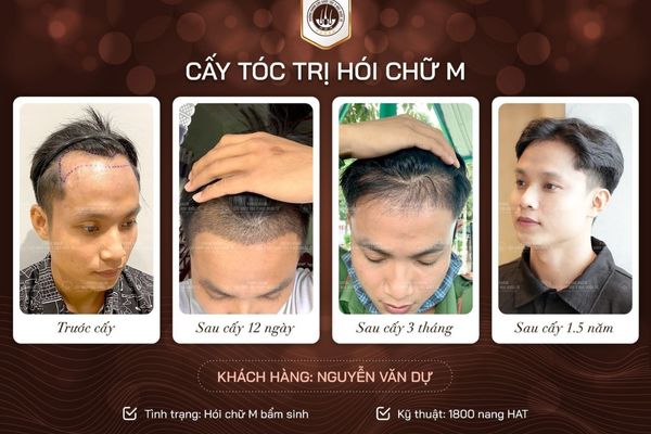 Mách bạn cách khắc phục rụng tóc ở tuổi 16 hiệu quả Mách bạn cách khắc phục rụng tóc ở tuổi 16 hiệu quả