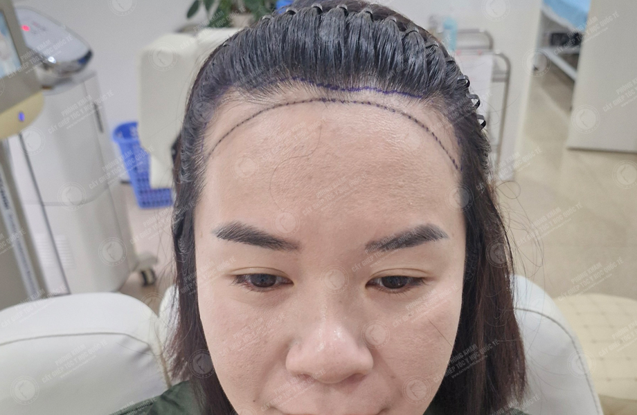 Đinh Thu Huyền - Cấy tóc đường chữ M 2