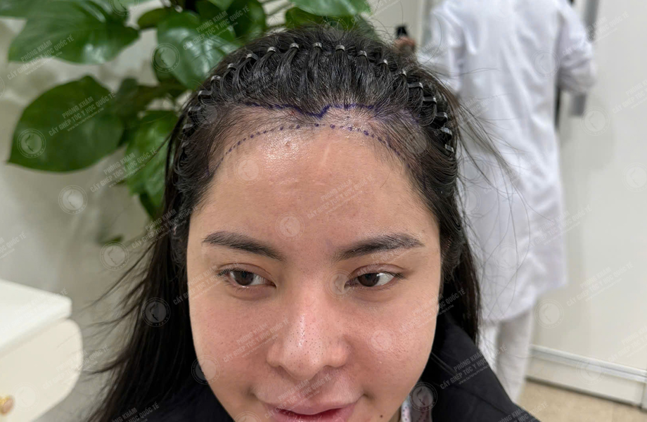 Nguyễn Như Nguyệt - Cấy tóc đường chữ M 2