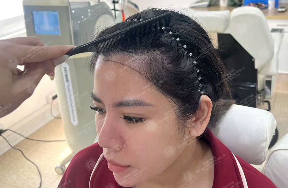 Hoàng Khánh Ly - Cấy tóc đường chữ M 2