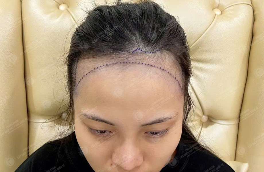 Nguyễn Bảo Lan - Cấy tóc đường chữ M 2