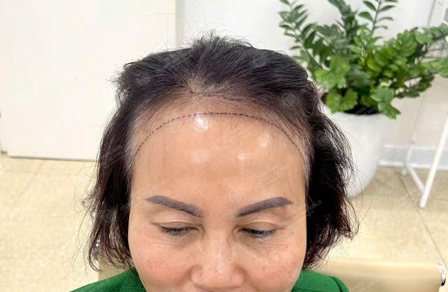 Đỗ Thanh Tâm - Cấy tóc đường chữ M 2