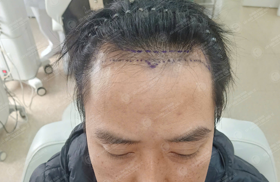 Nguyễn Đăng Khoa - Cấy tóc đường chữ M 2