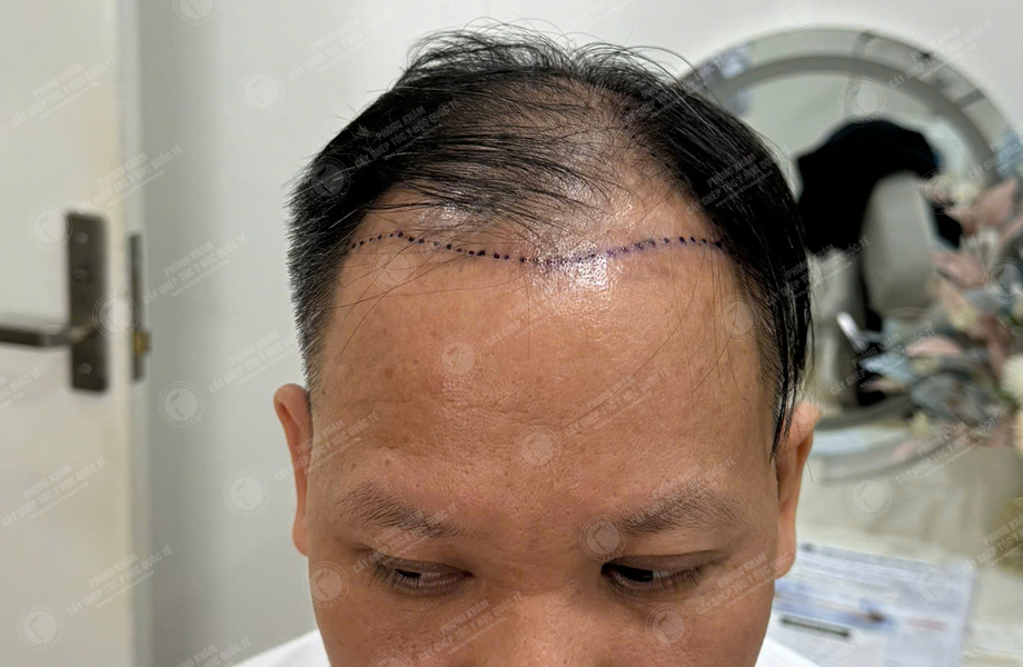 Nguyễn Hồng Quang - Cấy tóc đường chữ M 2