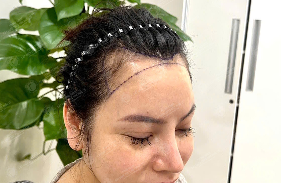 Nguyễn Thùy Phương - Cấy tóc đường chữ M 2