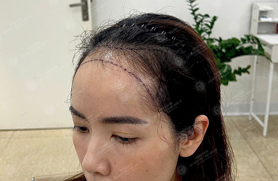 Nguyễn Thảo Chi - Cấy tóc đường chữ M 2