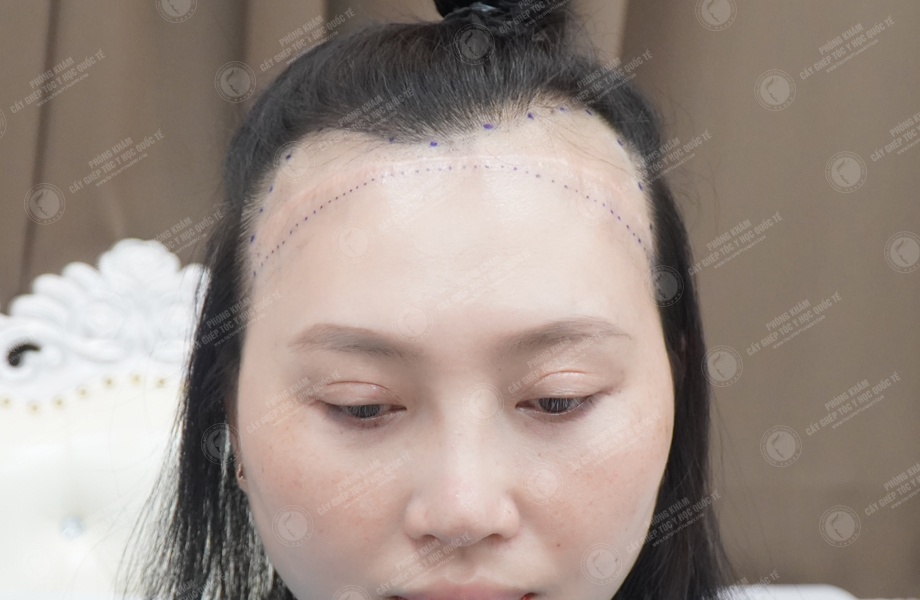 Nguyễn Minh Thư - Cấy tóc đường chữ M 2