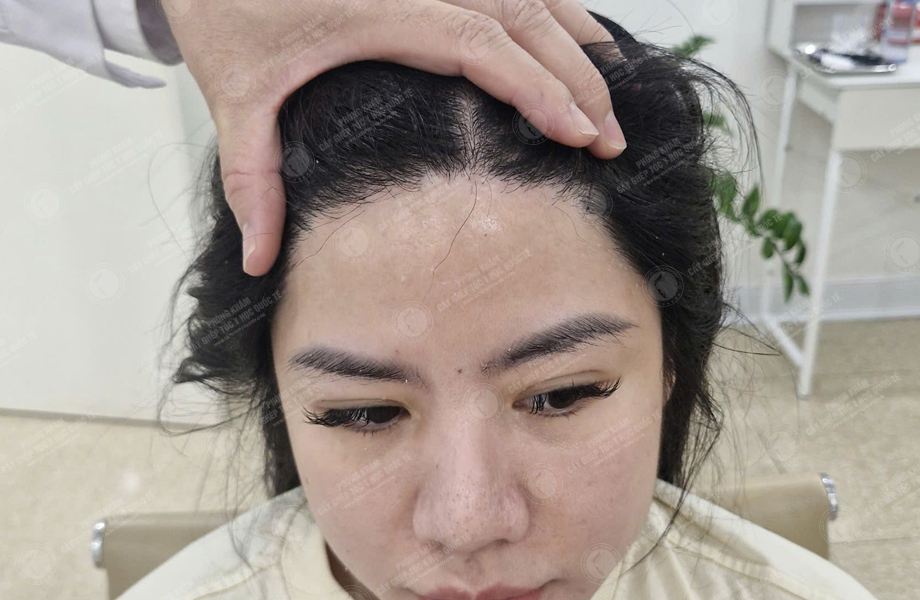 Hoàng Khánh Ly - Cấy tóc đường chữ M 11