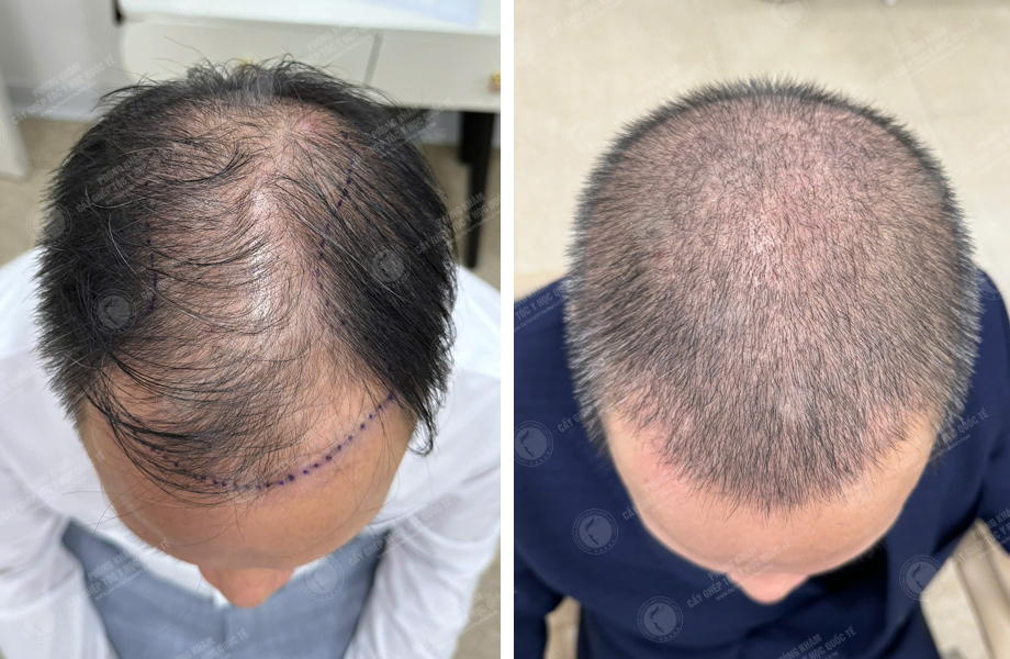 Nguyễn Hồng Quang - Cấy tóc đường chữ M 1