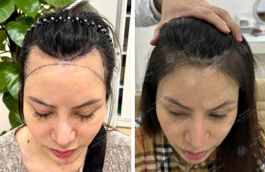  Nguyễn Thùy Phương - Cấy tóc tự thân 1