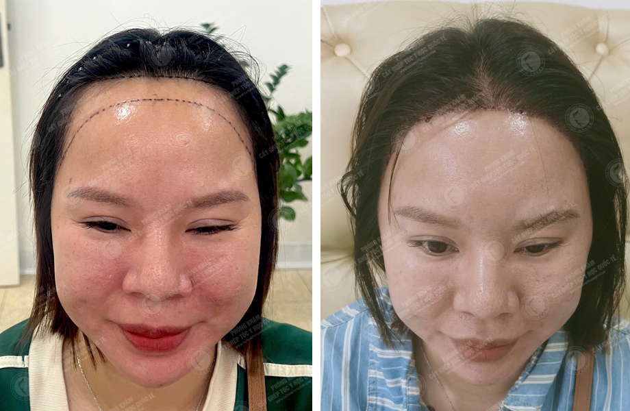  Nguyễn Thị Lệ - Cấy tóc đường chữ M 1