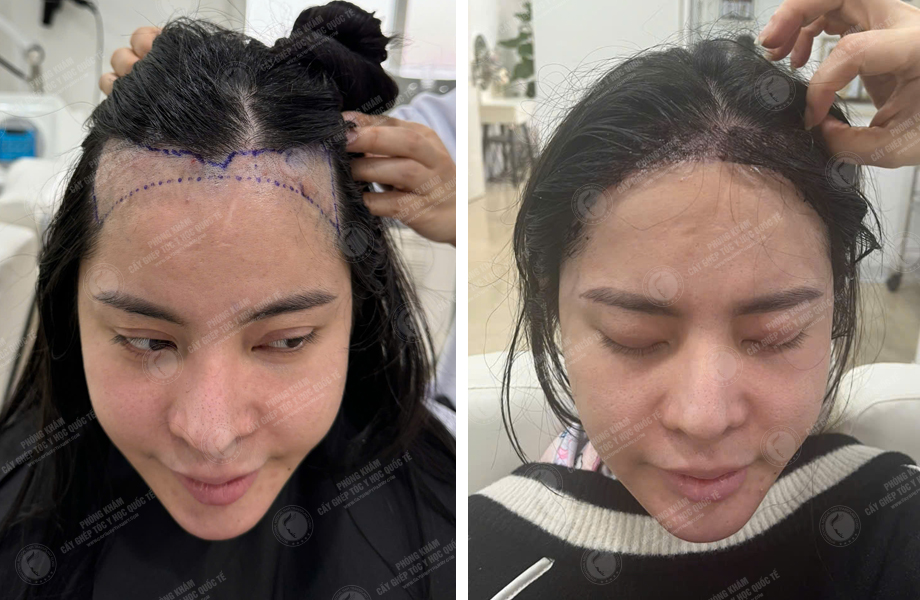  Nguyễn Như Nguyệt - Cấy tóc đường chữ M 1