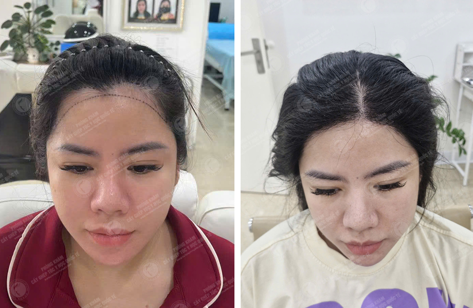  Hoàng Khánh Ly - Cấy tóc đường chữ M 1