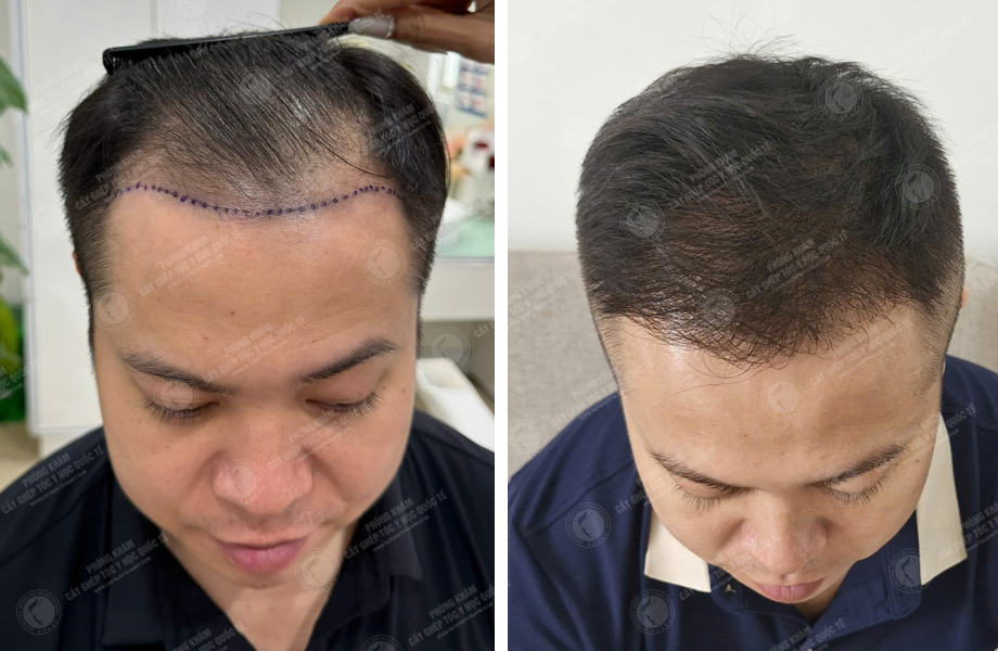  Nguyễn Duy Hùng - Cấy tóc đường chữ M 1