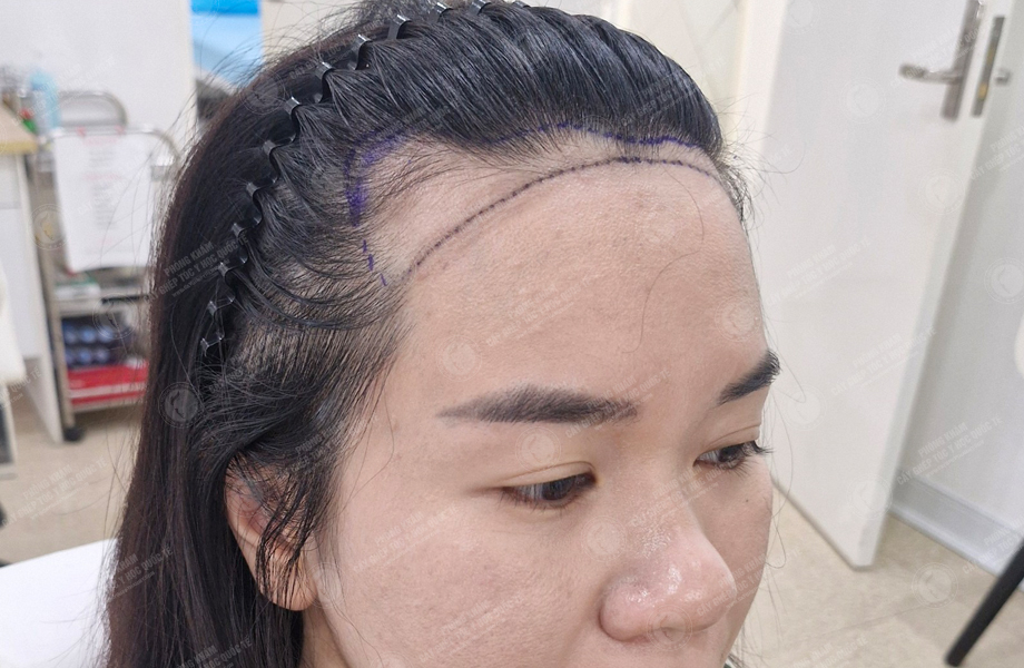 Đinh Thu Huyền - Cấy tóc đường chữ M 3