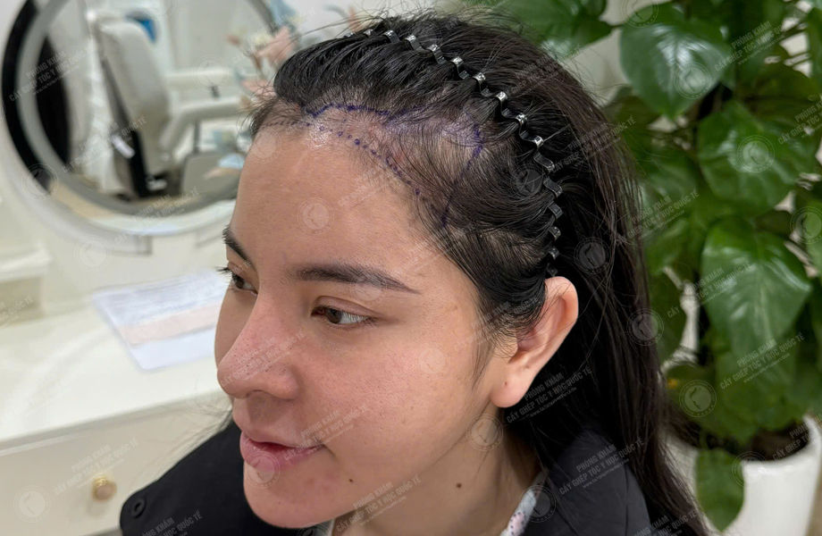 Nguyễn Như Nguyệt - Cấy tóc đường chữ M 3