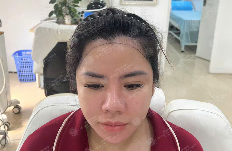 Hoàng Khánh Ly - Cấy tóc đường chữ M 3