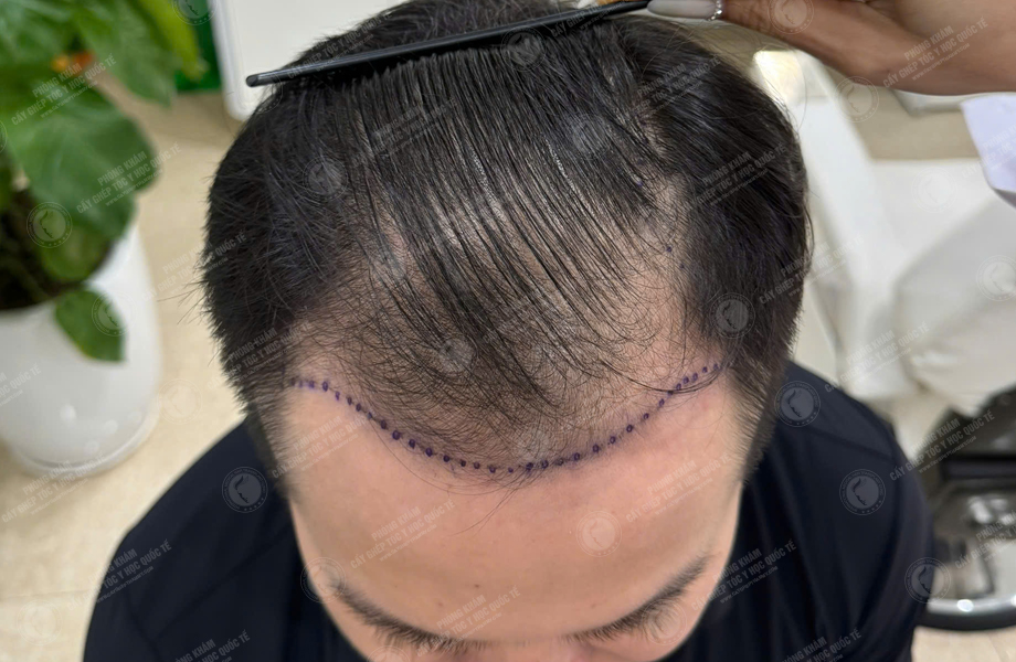 Nguyễn Duy Hùng - Cấy tóc đường chữ M 3