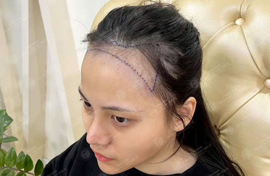 Nguyễn Bảo Lan - Cấy tóc đường chữ M 3