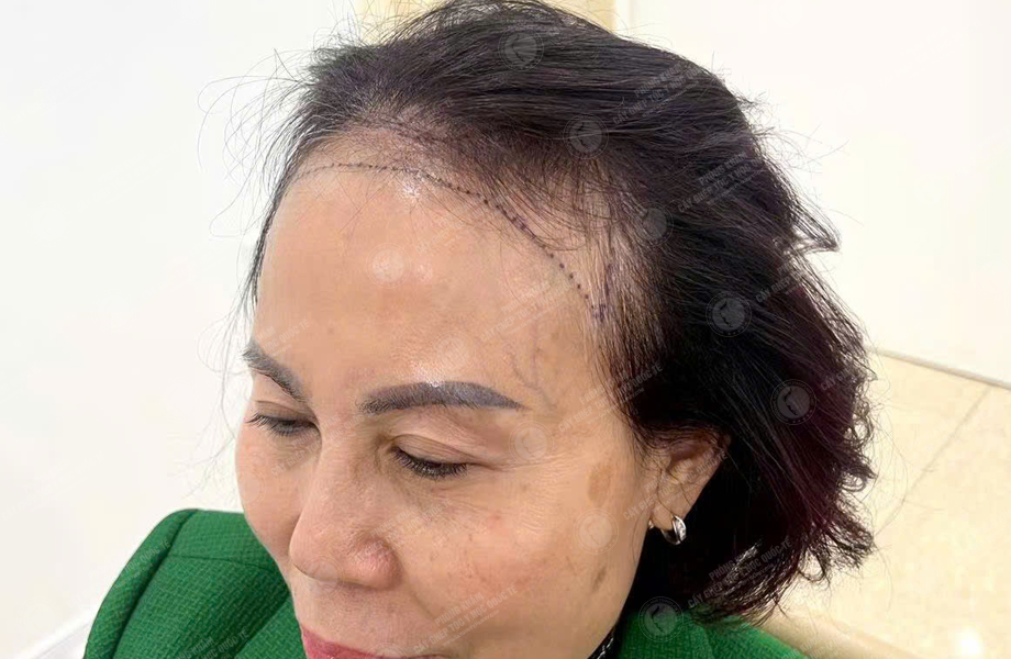 Đỗ Thanh Tâm - Cấy tóc đường chữ M 3