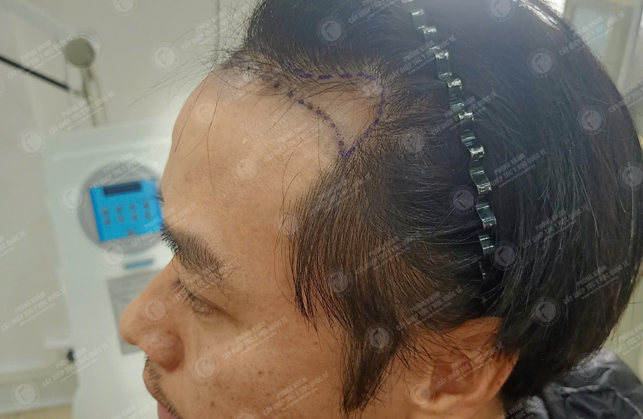 Nguyễn Đăng Khoa - Cấy tóc đường chữ M 3