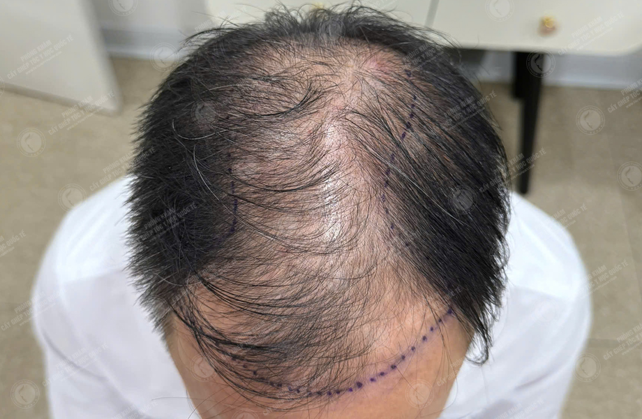Nguyễn Hồng Quang - Cấy tóc đường chữ M 3