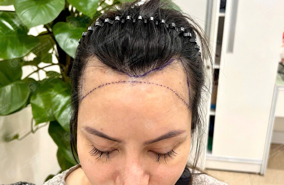 Nguyễn Thùy Phương - Cấy tóc đường chữ M 3