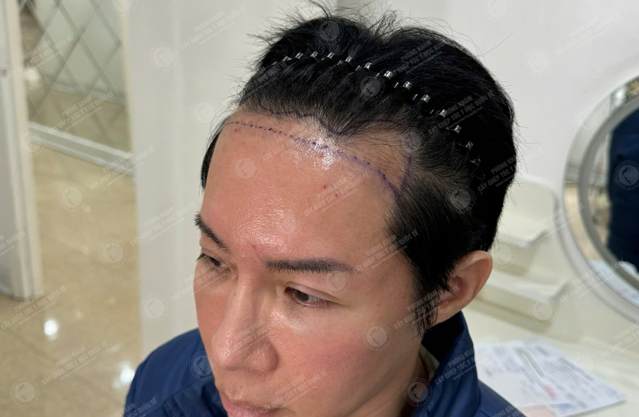 Nguyễn Hồng Đăng - Cấy tóc đường chữ M 3